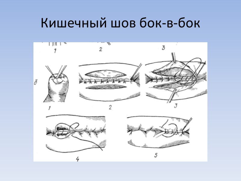 Кишечный шов бок-в-бок